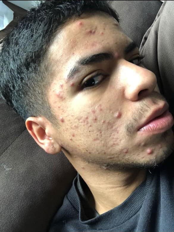 Pele antes e depois de membro da comunidade - Antes
