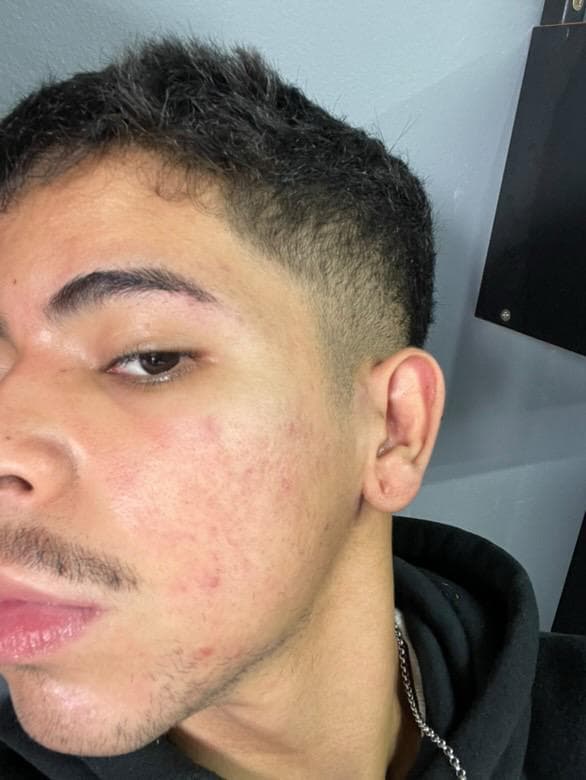 Pele antes e depois de membro da comunidade - Depois